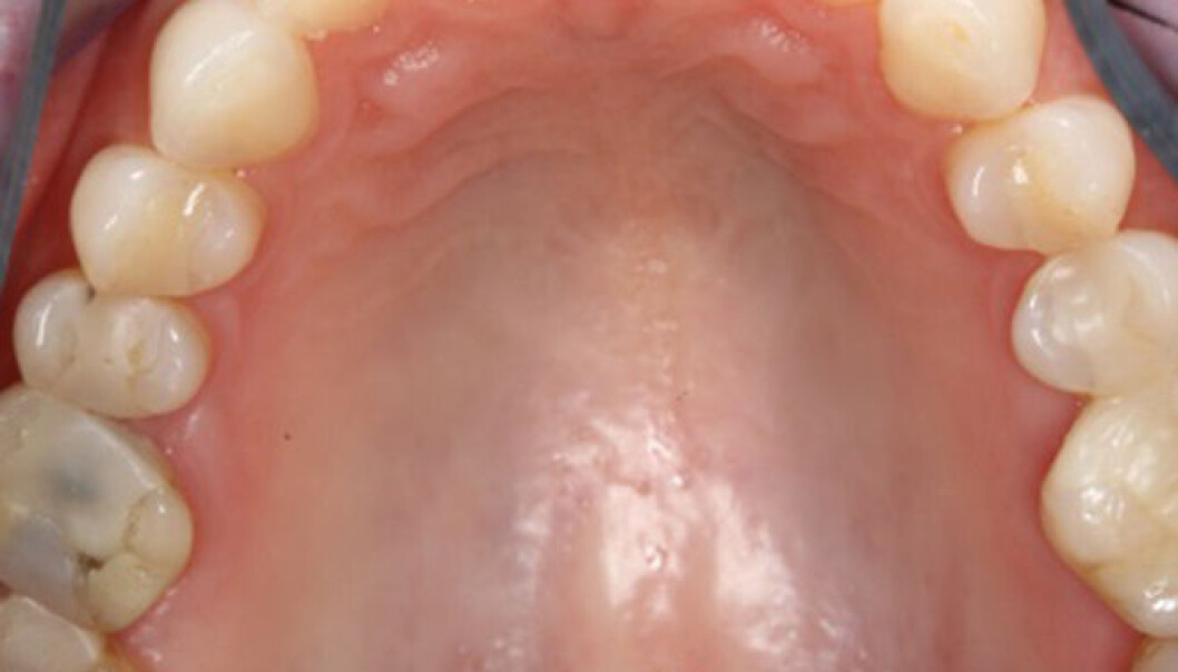Pasienter med Sjögrens syndrom har lite spytt i munnen. Man kan tydelig se at det er svinnende lite spytt i munnen til denne pasienten med Sjögrens syndrom. (Foto: Munntørrhetklinikken) Pasienter med Sjögrens syndrom har lite spytt i munnen. Man kan tydelig se at det er svinnende lite spytt i munnen til denne pasienten med Sjögrens syndrom. (Foto: Munntørrhetklinikken)