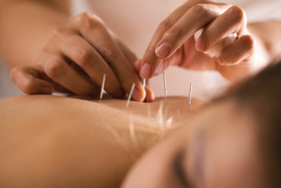Akupunkturbehandlinger ser ut til å lindre hetetokter, tørr hud og andre symptomer på overgangsalderen i ny studie. (Foto: Studio 72 / Shutterstock / NTB scanpix)