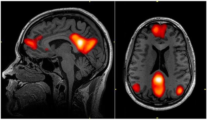 De røde områdene er steder som normalt er synkronisert med hverandre i et nettverk som kalles «default mode network», men psilocybin får dem til å miste takten. Ifølge Martin Korshøy Madsen kan det være årsaken til at opplevelsen av «selvet» reduseres når man inntar psilocybin. (Foto: John Graner et al. 2013) De røde områdene er steder som normalt er synkronisert med hverandre i et nettverk som kalles «default mode network», men psilocybin får dem til å miste takten. Ifølge Martin Korshøy Madsen kan det være årsaken til at opplevelsen av «selvet» reduseres når man inntar psilocybin. (Foto: John Graner et al. 2013)