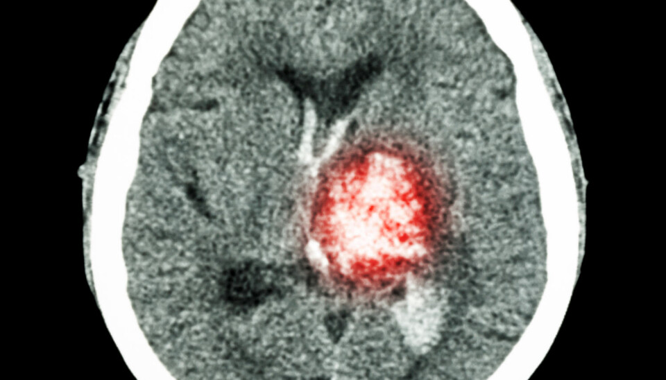Bildet viser en pasient som har fått hjerneslag på grunn av en blødning i hjernen.  (Foto: Shutterstock, NTB Scanpix)