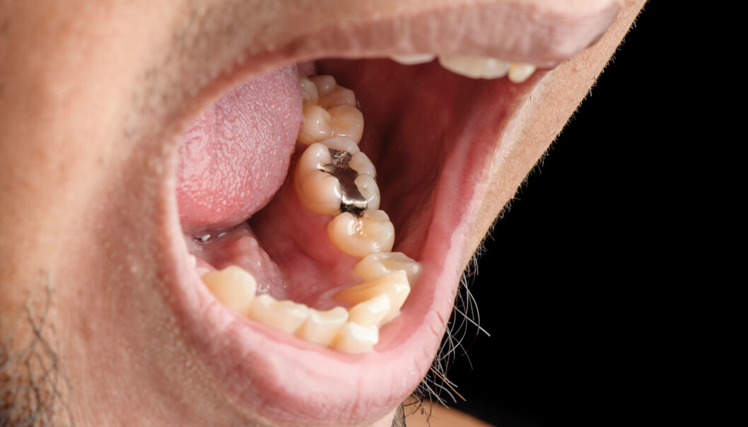 Da pasienter med generelle helseplager fikk fjernet amalgamfyllingene sine, opplevde de bedring. Men forskere er ikke sikre på om det skyldes fyllingene. (Illustrasjonsfoto: Colourbox) Da pasienter med generelle helseplager fikk fjernet amalgamfyllingene sine, opplevde de bedring. Men forskere er ikke sikre på om det skyldes fyllingene. (Illustrasjonsfoto: Colourbox)