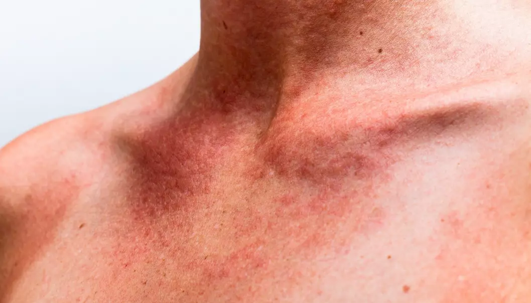 Forskerne oppdager nå den ene nye allergien etter den andre, og det er ikke så rart. (Foto: Colourbox)