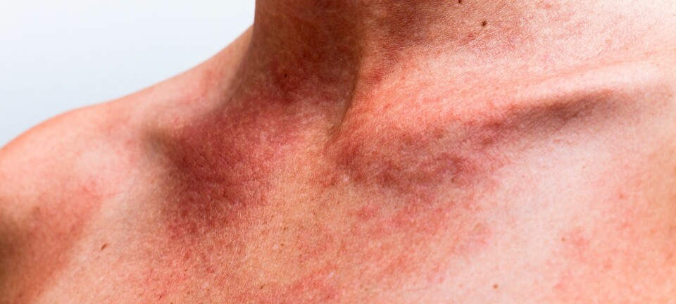 Forskerne oppdager nå den ene nye allergien etter den andre, og det er ikke så rart. (Foto: Colourbox)