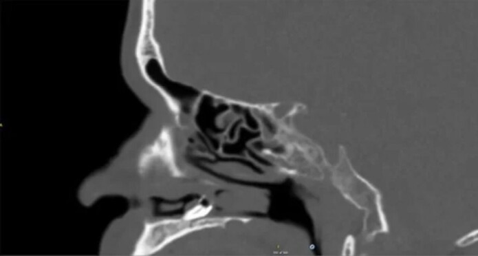 CT-skanningen avslørte at det sannsynligvis var en tann som hadde satt seg på tvers. (Copyright 2019 BMJ Case Reports) CT-skanningen avslørte at det sannsynligvis var en tann som hadde satt seg på tvers. (Copyright 2019 BMJ Case Reports)