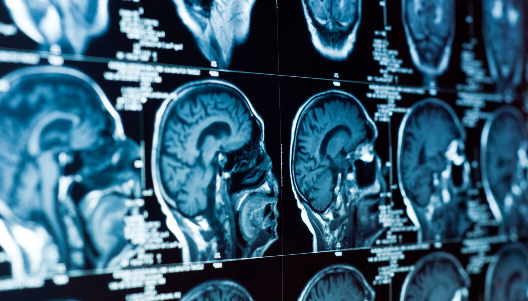 Det finnes mange indikasjoner på at genetikk kan være med i bildet – men bevisene er uklare. Noen ser på hjernestørrelsen. Mye tyder på at størrelsen korrelerer med intelligensen. Det finnes også bevis på at svarte i gjennomsnitt har mindre hjerne enn hvite. Korrelasjonen viser imidlertid ingen kausal sammenheng, skriver Tunstad. (Foto: SvedOliver, Shutterstock, NTB scanpix) Det finnes mange indikasjoner på at genetikk kan være med i bildet – men bevisene er uklare. Noen ser på hjernestørrelsen. Mye tyder på at størrelsen korrelerer med intelligensen. Det finnes også bevis på at svarte i gjennomsnitt har mindre hjerne enn hvite. Korrelasjonen viser imidlertid ingen kausal sammenheng, skriver Tunstad. (Foto: SvedOliver, Shutterstock, NTB scanpix)