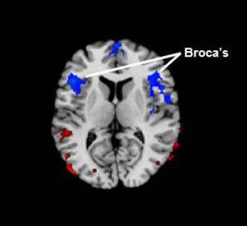 Broca's område ligger i hjernens frontallapp. Den blå fargen representerer redusert blodgjennomstrømming hos barn og voksne med stamming sammenlignet med folk som ikke stammet. (Foto: (Figur: Children's Hospital Los Angeles)) Broca's område ligger i hjernens frontallapp. Den blå fargen representerer redusert blodgjennomstrømming hos barn og voksne med stamming sammenlignet med folk som ikke stammet. (Foto: (Figur: Children's Hospital Los Angeles))