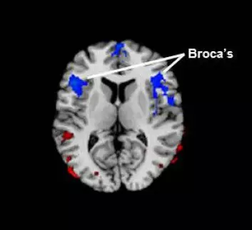 Broca's område ligger i hjernens frontallapp. Den blå fargen representerer redusert blodgjennomstrømming hos barn og voksne med stamming sammenlignet med folk som ikke stammet. (Foto: (Figur: Children's Hospital Los Angeles))