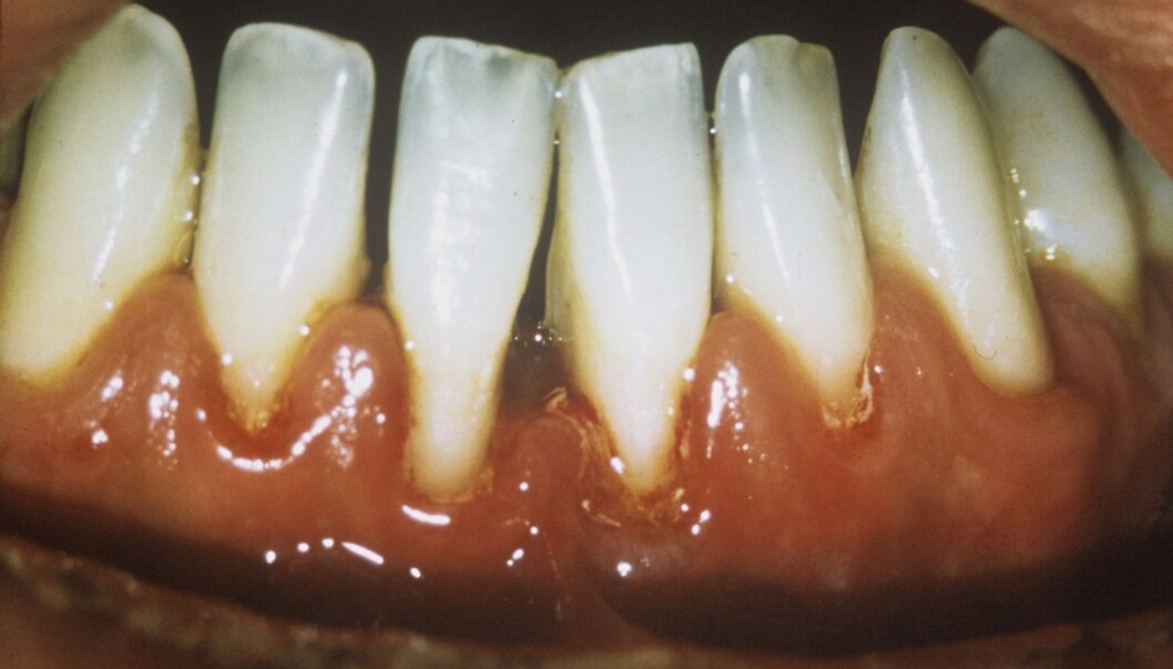 Periodontitt ødelegger vevet rundt tennene, både på siden av tanna og under den. Her har tannkjøttet blitt ødelagt og trekker seg tilbake, slik at det danner seg mellomrom mellom tennene. (Foto: Science Photo Library) Periodontitt ødelegger vevet rundt tennene, både på siden av tanna og under den. Her har tannkjøttet blitt ødelagt og trekker seg tilbake, slik at det danner seg mellomrom mellom tennene. (Foto: Science Photo Library)