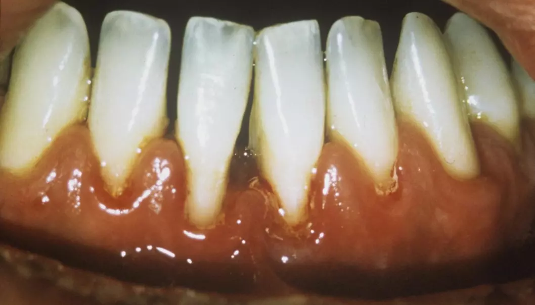 Melkesyrebakterie kan bekjempe vanlig tannsykdom