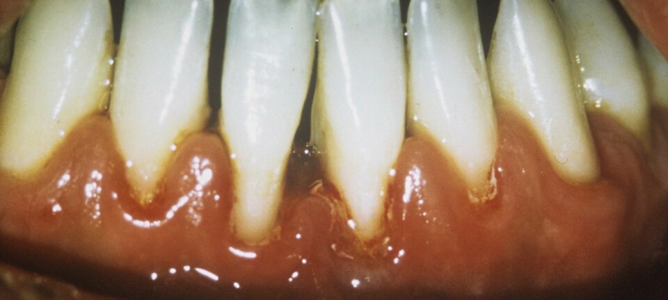 Periodontitt ødelegger vevet rundt tennene, både på siden av tanna og under den. Her har tannkjøttet blitt ødelagt og trekker seg tilbake, slik at det danner seg mellomrom mellom tennene.  (Foto: Science Photo Library)