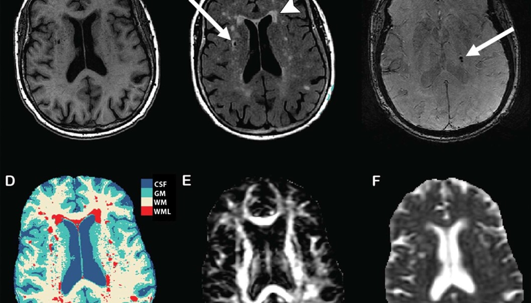 Disse MR-bildene av hjerner viser ulike former for hjerneskade. B viser skader på den hvite hjernemassen, markert med pil. (Foto: Radiological Society of North America) Disse MR-bildene av hjerner viser ulike former for hjerneskade. B viser skader på den hvite hjernemassen, markert med pil. (Foto: Radiological Society of North America)