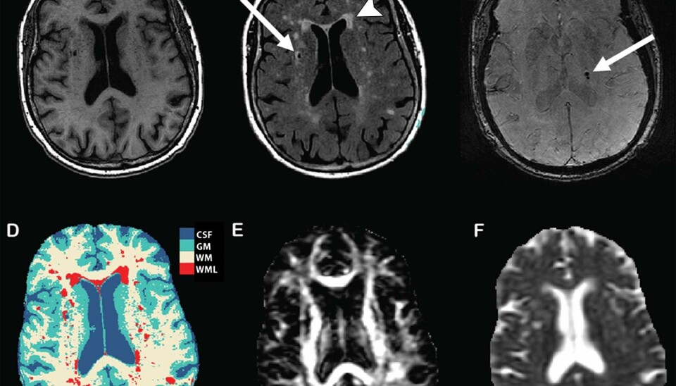 Disse MR-bildene av hjerner viser ulike former for hjerneskade. B viser skader på den hvite hjernemassen, markert med pil. (Foto: Radiological Society of North America)