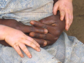 - Det eksisterer for lite lokal kunnskap om albinisme i Malawi. Folk flest vet ikke at det er en arvelig tilstand, skriver forfatterne av denne kronikken. (Foto: Stine Hellum Braathen) - Det eksisterer for lite lokal kunnskap om albinisme i Malawi. Folk flest vet ikke at det er en arvelig tilstand, skriver forfatterne av denne kronikken. (Foto: Stine Hellum Braathen)