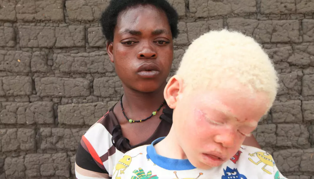 Edna Cedrick (26) hadde tvillinger, begge med albinisme. Nå har hun bare én sønn igjen. Den andre ble revet vekk fra henne og drept av mennesker som ønsket å selge kroppsdelene hans til høystbydende. (Foto: Tsvangirayi Mukwazhi / NTB Scanpix)