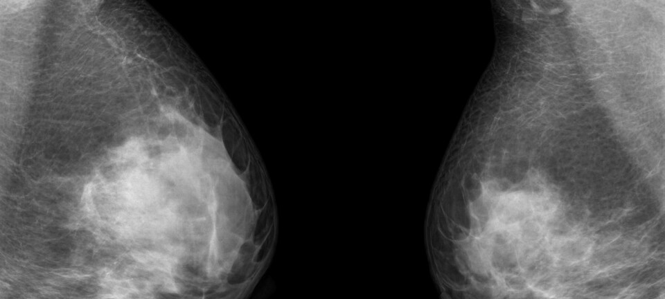 Aggressiv brystkreft er vanskelig å behandle. Nå kan man ha funnet en ny medisin som fungerer.  (Foto: thailoei92/Shutterstock/NTB scanpix)