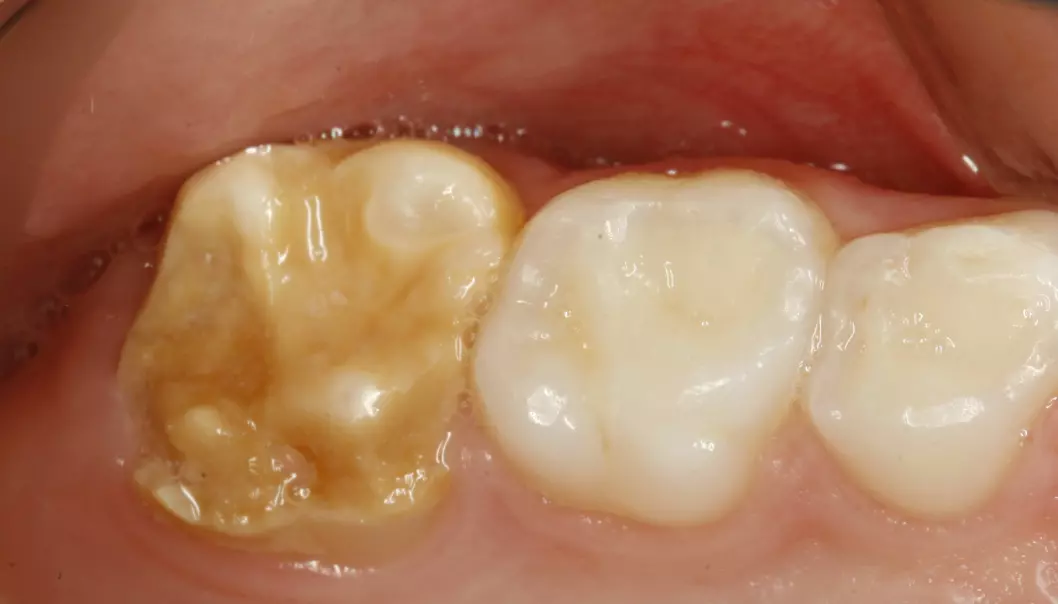 Hos noen barn blir ikke tannemaljen utviklet som den skal. Hvis dette skjer med bare enkelte tenner, og ikke alle, kalles tilstanden for Molar Incisor hypomineralization, som blir forkortet til MIH. Her er tennene til en syvåring med MIH på 6-års jekselen.  (Foto: Universitetet i Oslo)