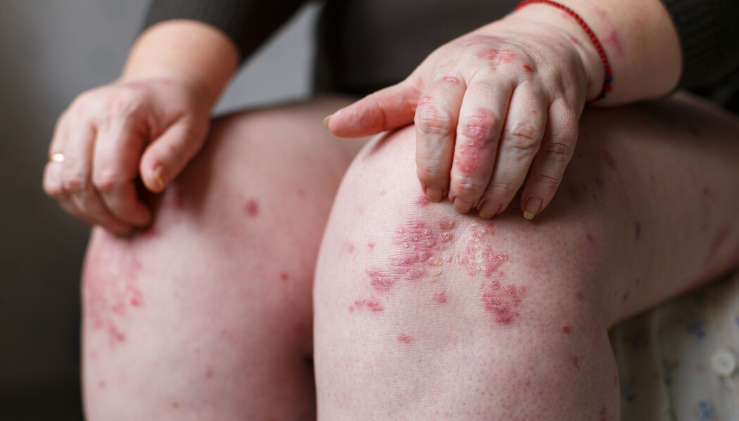 Risikoen økte med ni prosent for hvert høyere hele tall på BMI-skalaen, ifølge ny studie. (Illustrasjonsfoto: Ternavskaia Olga Alibec / Shutterstock / NTB scanpix) Risikoen økte med ni prosent for hvert høyere hele tall på BMI-skalaen, ifølge ny studie. (Illustrasjonsfoto: Ternavskaia Olga Alibec / Shutterstock / NTB scanpix)