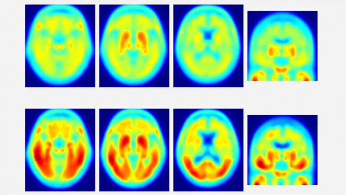 Disse tau-PET-bildene ble offentliggjort av demensforskere ved Washington University i St. Louis i Missouri tidligere i år. De øverste bildene viser svært lite tau-protein hos friske mennesker som ble undersøkt. De nederste bildene viser tau i hjernen til pasienter som har milde symptomer på demens. I denne amerikanske studien ble det slått fast at dess mer tau-protein forskerne så på skannerbildene sine, dess større problemer hadde vedkommende person med å svare riktig i tester av hukommelse og oppmerksomhet. Disse tau-PET-bildene ble offentliggjort av demensforskere ved Washington University i St. Louis i Missouri tidligere i år. De øverste bildene viser svært lite tau-protein hos friske mennesker som ble undersøkt. De nederste bildene viser tau i hjernen til pasienter som har milde symptomer på demens. I denne amerikanske studien ble det slått fast at dess mer tau-protein forskerne så på skannerbildene sine, dess større problemer hadde vedkommende person med å svare riktig i tester av hukommelse og oppmerksomhet.