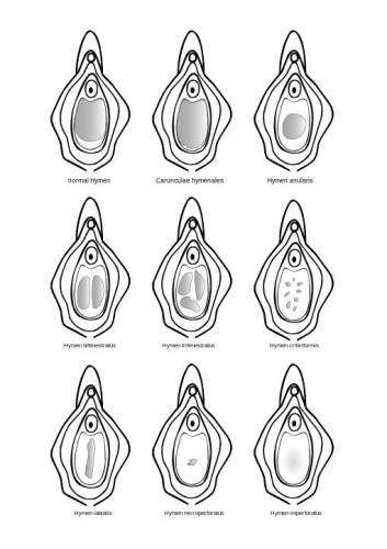Forskjellige skjedekranser (Foto: Hymen_ger.svg: *Typy_panenských_blan.svg: FollowTheMediaderivative work: Hic et nunc (talk) - Hymen_ger.svg, CC BY-SA 3.0, https://commons.wikimedia.org/w/index.php?curid=9533927) Forskjellige skjedekranser (Foto: Hymen_ger.svg: *Typy_panenských_blan.svg: FollowTheMediaderivative work: Hic et nunc (talk) - Hymen_ger.svg, CC BY-SA 3.0, https://commons.wikimedia.org/w/index.php?curid=9533927)