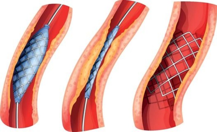 En stent brukes for å hjelpe tette blodårer rundt hjertet å holde seg åpne. Når stenten settes inn blåses blodåra opp med en ballong først, før en metallstent eller en medikamentstent settes inn. (Foto: (Figur: Colourbox)) En stent brukes for å hjelpe tette blodårer rundt hjertet å holde seg åpne. Når stenten settes inn blåses blodåra opp med en ballong først, før en metallstent eller en medikamentstent settes inn. (Foto: (Figur: Colourbox))