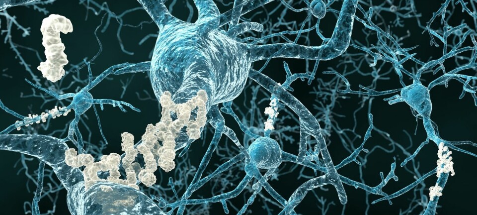 Hjerneceller med plakk.  Juan Gaertner / Shutterstock / NTB scanpix