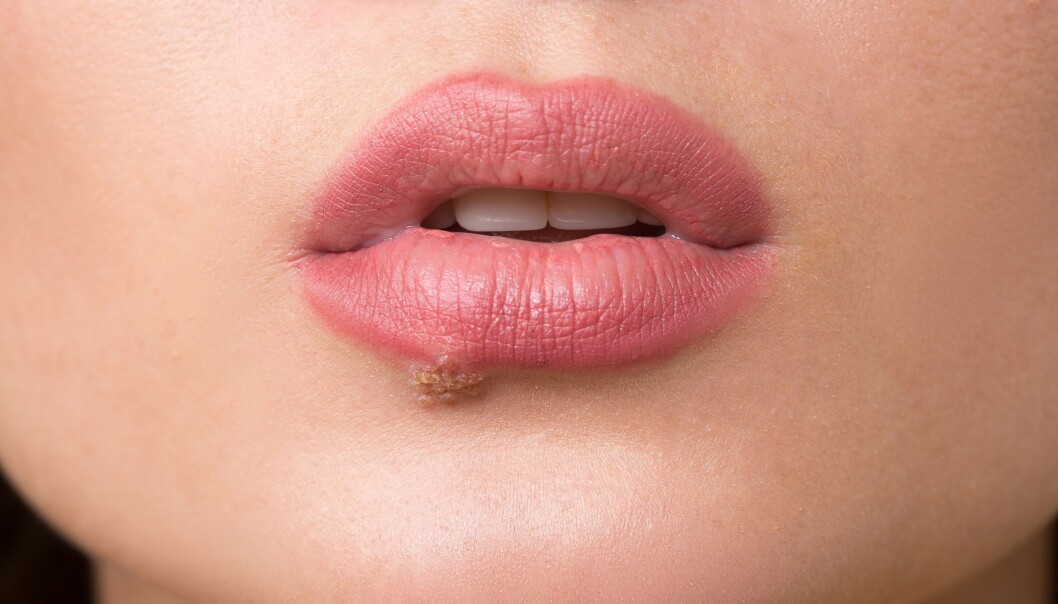 Herpesviruset er svært vanlig i Norge. Det kan i perioder være plagsomt for mange. Men forsøk på mus tyder på at det kan beskytte mot listeria og svartedauden. (Illustrasjonsfoto: Colourbox) Herpesviruset er svært vanlig i Norge. Det kan i perioder være plagsomt for mange. Men forsøk på mus tyder på at det kan beskytte mot listeria og svartedauden. (Illustrasjonsfoto: Colourbox)
