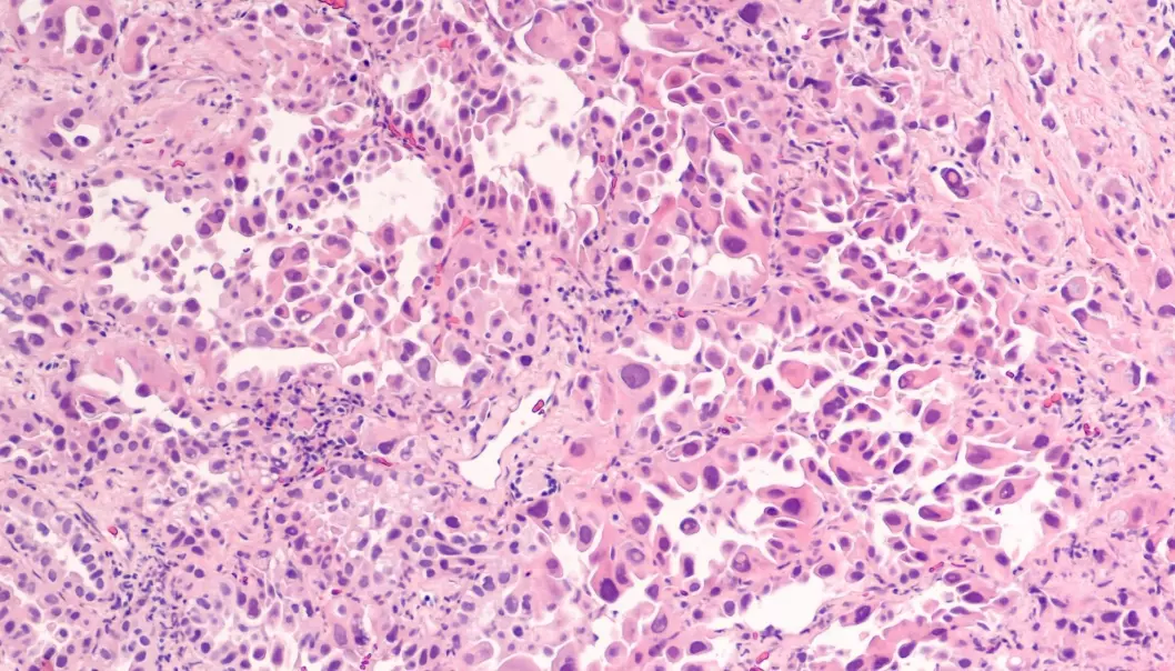 Kreftbehandlingen kan bli bedre dersom man kjenner detaljene om alle celletypene i svulsten. Dette er et mikroskop-bilde av lungekreft. (Illustrasjon: David Litman / Shutterstock / NTB scanpix).