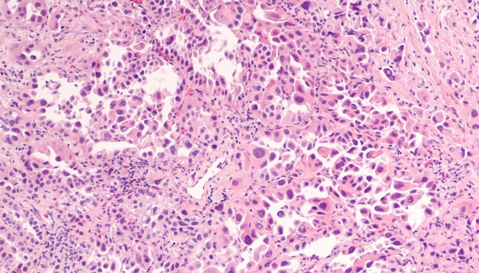 Kreftbehandlingen kan bli bedre dersom man kjenner detaljene om alle celletypene i svulsten. Dette er et mikroskop-bilde av lungekreft. (Illustrasjon: David Litman / Shutterstock / NTB scanpix).