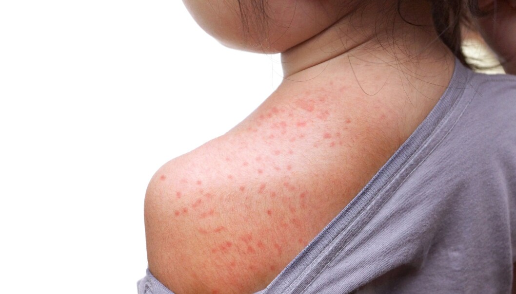 Personer med dårlig immunforsvar eller personer som ikke er vaksinerte, bør holde seg unna områder med mye meslinger, råder professor ved UiT, Ørjan Olsvik. (Illustrasjonsbilde: wk1003mike / Shutterstock / NTB scanpix) Personer med dårlig immunforsvar eller personer som ikke er vaksinerte, bør holde seg unna områder med mye meslinger, råder professor ved UiT, Ørjan Olsvik. (Illustrasjonsbilde: wk1003mike / Shutterstock / NTB scanpix)