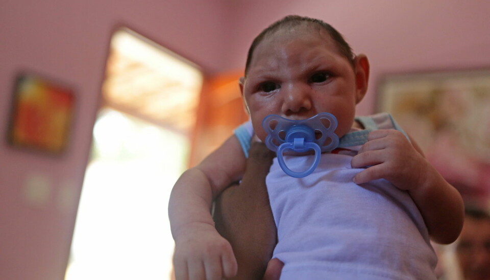 Bildet viser den brasilianske babyen Luiz Philipe i Marica, Rio de Janeiro, som har mikrocefali. Zikavirus mistenkes for å være årsaken.  (Foto: Zuma Press/Scanpix)