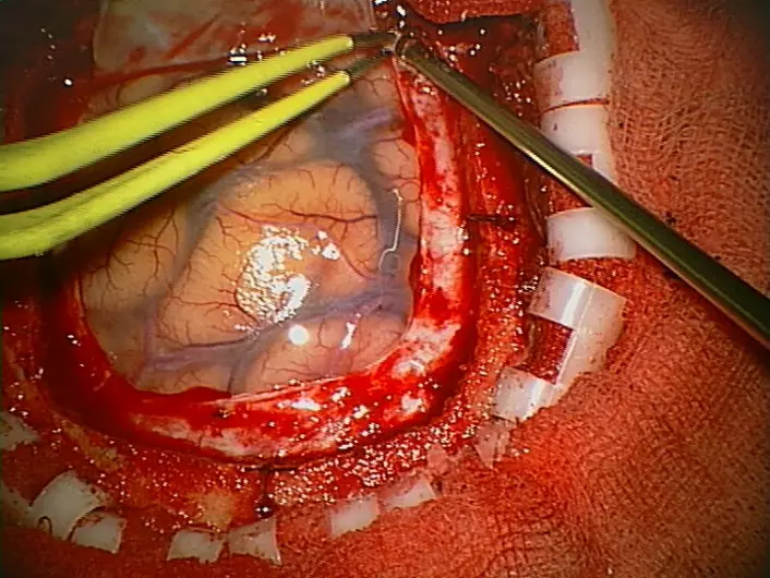 Slik ser en vanlig kraniotomi ut. Kraniotomi er en operasjon hvor kirurgen fjerner en del av skallen for å få tilgang til selve hjernen. (Foto: CHUV (Lausanne)/Wikimedia commons)