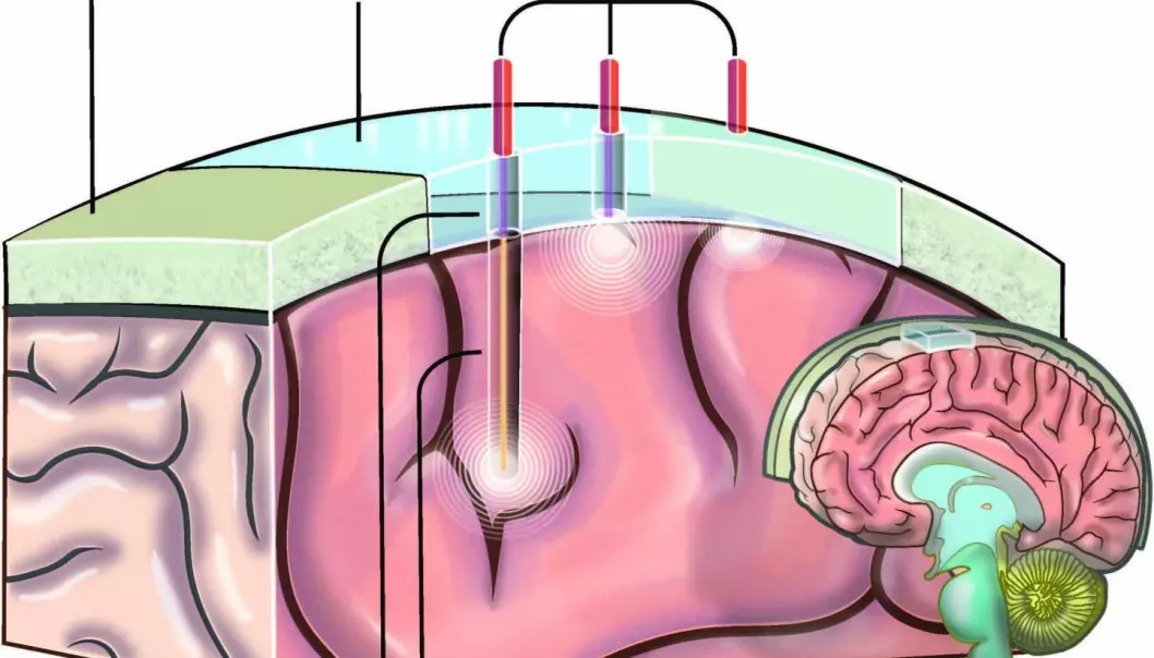 En illustrasjon av hvordan vinduet inn til hjernen ville blitt plassert.  (Illustrasjon: UC Riverside)