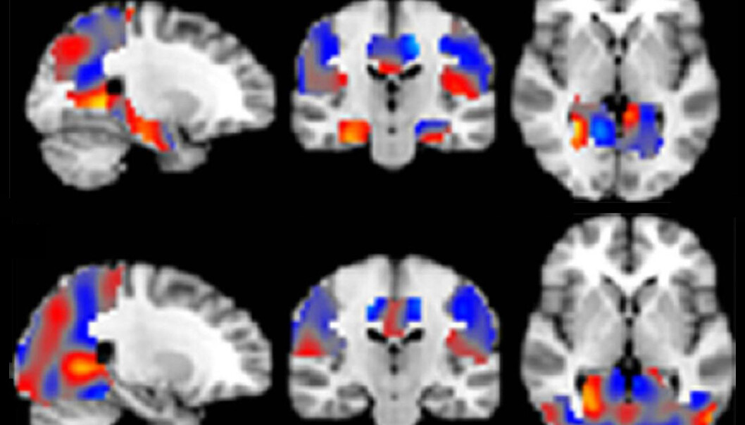 Kunstig intelligens klarer å skille Alzheimer fra andre former for svekkelser i hjernen. Hjerneskanningene er fargekodet av den kunstige intelligensen. Rødt er områder som indikerer Alzheimer. Blått er områder som indikerer mildere og mer alminnelige former for svekkelse. (Figur: Radiological Society of North America) Kunstig intelligens klarer å skille Alzheimer fra andre former for svekkelser i hjernen. Hjerneskanningene er fargekodet av den kunstige intelligensen. Rødt er områder som indikerer Alzheimer. Blått er områder som indikerer mildere og mer alminnelige former for svekkelse. (Figur: Radiological Society of North America)
