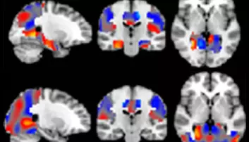 Kunstig intelligens oppdager Alzheimer