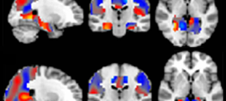 Kunstig intelligens klarer å skille Alzheimer fra andre former for svekkelser i hjernen. Hjerneskanningene er fargekodet av den kunstige intelligensen. Rødt er områder som indikerer Alzheimer. Blått er områder som indikerer mildere og mer alminnelige former for svekkelse. (Figur: Radiological Society of North America)