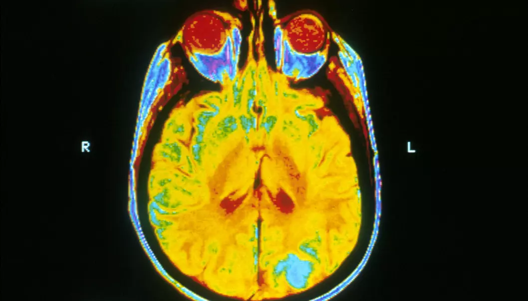 Dette bildet er av en hjerne hvor den blå fargen viser hjernekreft. Det tatt med MRI-maskin (magnetic resonance imaging).  (Foto: National Cancer Institute/Wikimedia)