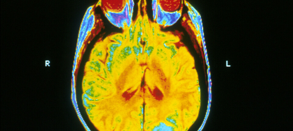 Dette bildet er av en hjerne hvor den blå fargen viser hjernekreft. Det tatt med MRI-maskin (magnetic resonance imaging).  (Foto: National Cancer Institute/Wikimedia)
