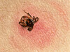 Borreliainfeksjon