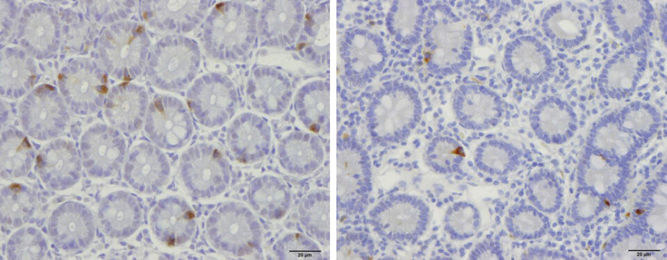 Bildet viser at prøven fra en frisk person (til venstre) har flere endokrine celler enn prøven fra en IBS-pasient. (Foto: Magdy El-Salhy/World Journal of Gastroenterology)