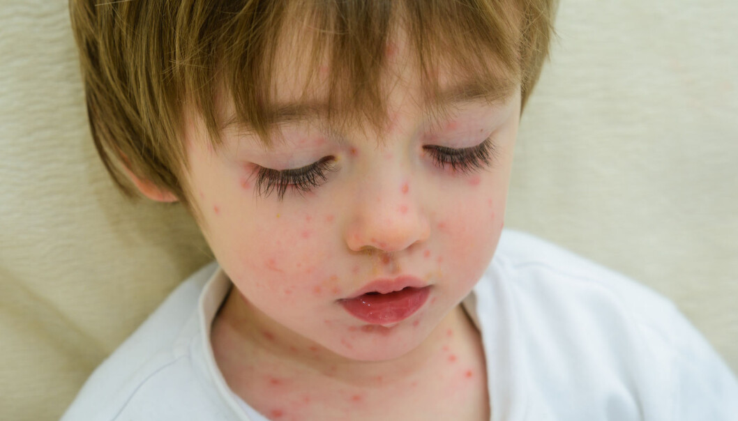 Det kan være greit å vite når et utbrudd av plagsomme vannkopper nærmer seg. (Foto: Shutterstock, NTB scanpix) Det kan være greit å vite når et utbrudd av plagsomme vannkopper nærmer seg. (Foto: Shutterstock, NTB scanpix)