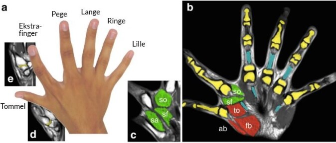 Skanningen til høyre viser at den ekstra fingeren, som sitter mellom tommel- og pekefingeren, støttes av noen ekstra muskler og nerver som man ikke finner i en normal hånd med fem fingre. (C. Mehring, M. Akselrod) Skanningen til høyre viser at den ekstra fingeren, som sitter mellom tommel- og pekefingeren, støttes av noen ekstra muskler og nerver som man ikke finner i en normal hånd med fem fingre. (C. Mehring, M. Akselrod)