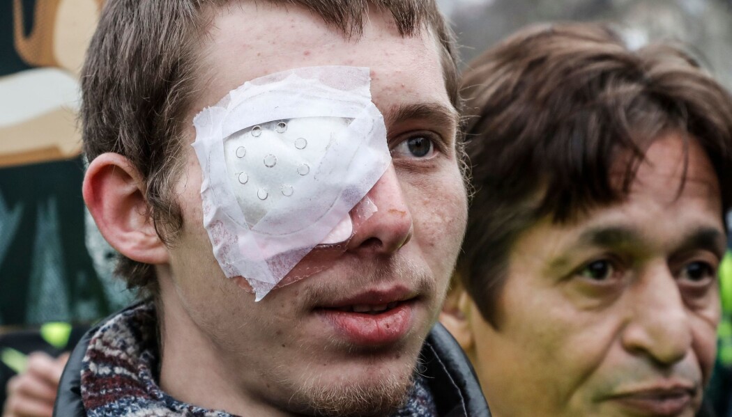 Franck Didron sier han ble skutt i øyet med en gummikule under en demonstrasjon i Paris i desember i fjor. 20-åringen mistet synet på det høyre øyet. (Foto: Francois Guillot/AFP/NTB scanpix) Franck Didron sier han ble skutt i øyet med en gummikule under en demonstrasjon i Paris i desember i fjor. 20-åringen mistet synet på det høyre øyet. (Foto: Francois Guillot/AFP/NTB scanpix)