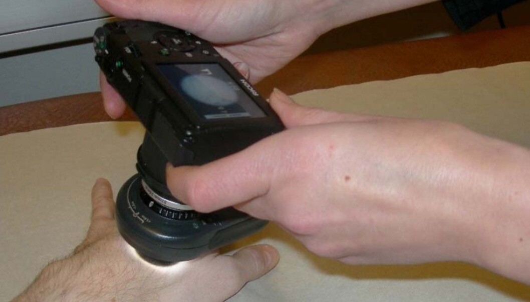 En føflekk undersøkes med et dermatoskop koblet til et digitalt kamera. (Foto: Kajsa Møllersen) En føflekk undersøkes med et dermatoskop koblet til et digitalt kamera. (Foto: Kajsa Møllersen)