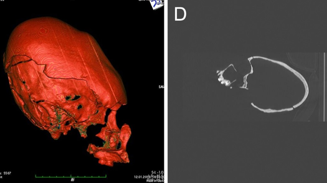 CT-skanninger av hodeskallene viser hvor deformerte de er. (Bilde: Fernandes, D. m.fl / Plos One) CT-skanninger av hodeskallene viser hvor deformerte de er. (Bilde: Fernandes, D. m.fl / Plos One)