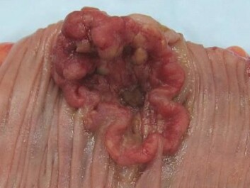 Cancer tumor in colon. (Photo: Emmanuelm, Wikimedia Commons) Cancer tumor in colon. (Photo: Emmanuelm, Wikimedia Commons)