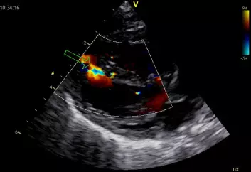 Dette ultralydbildet viser et lite hull i veggen mellom hjertekamrene. (Foto: Jarle Jortveit)
