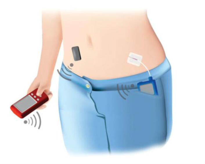 Slik ser et såkalt closed-loop system ut. Her ligger blodsukkermåleren rett under huden. Målingene sender den til en liten datamaskin, som regner ut hvor mye insulin som trengs. Maskinen sender dermed beskjed til insulinpumpen om hvor mye insulin den skal gi. (Foto: (Illustrasjon: Elleri, D., Dunger, D. og Hovorka, R.)) Slik ser et såkalt closed-loop system ut. Her ligger blodsukkermåleren rett under huden. Målingene sender den til en liten datamaskin, som regner ut hvor mye insulin som trengs. Maskinen sender dermed beskjed til insulinpumpen om hvor mye insulin den skal gi. (Foto: (Illustrasjon: Elleri, D., Dunger, D. og Hovorka, R.))