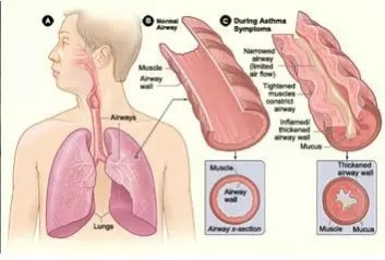 Mange samlestudier har vist økt risiko for luftveisplager og sykdommer hos de som bor i fuktskadde boliger. Illustrasjonen viser astma. (Foto: (Illustrasjon: FHI))