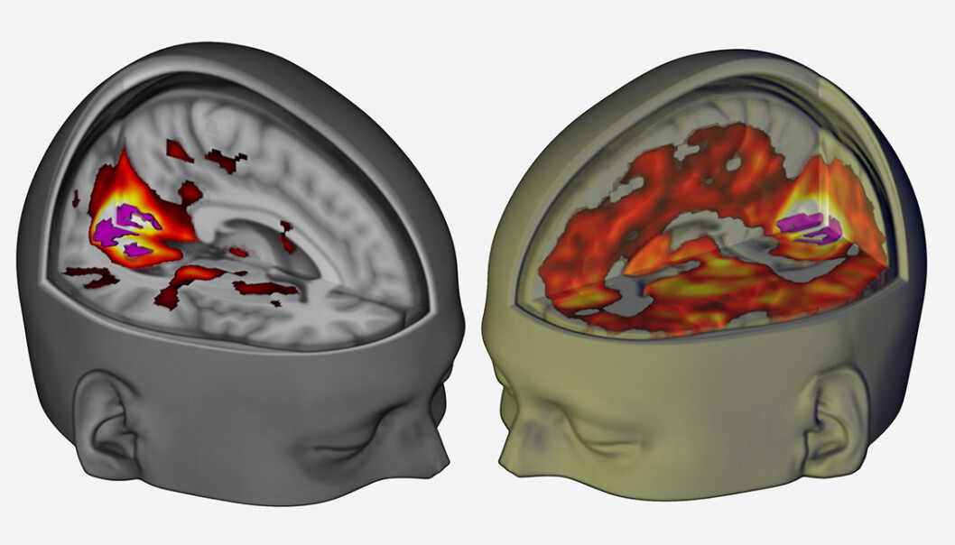 Mye mer av hjernen bidrar til synsopplevelser med LSD, som vist i bildet av forsøksperson med lukkede øyne til høyre. Forskere har nå for første gang brukt moderne skannemetoder til å undersøke hvordan hjerneaktiviteten påvirkes av LSD. (Figur: Imperial College London/Robin Carhart-Harris) Mye mer av hjernen bidrar til synsopplevelser med LSD, som vist i bildet av forsøksperson med lukkede øyne til høyre. Forskere har nå for første gang brukt moderne skannemetoder til å undersøke hvordan hjerneaktiviteten påvirkes av LSD. (Figur: Imperial College London/Robin Carhart-Harris)