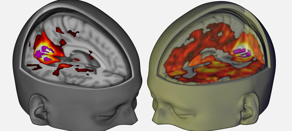Mye mer av hjernen bidrar til synsopplevelser med LSD, som vist i bildet av forsøksperson med lukkede øyne til høyre. Forskere har nå for første gang brukt moderne skannemetoder til å undersøke hvordan hjerneaktiviteten påvirkes av LSD. (Figur: Imperial College London/Robin Carhart-Harris)